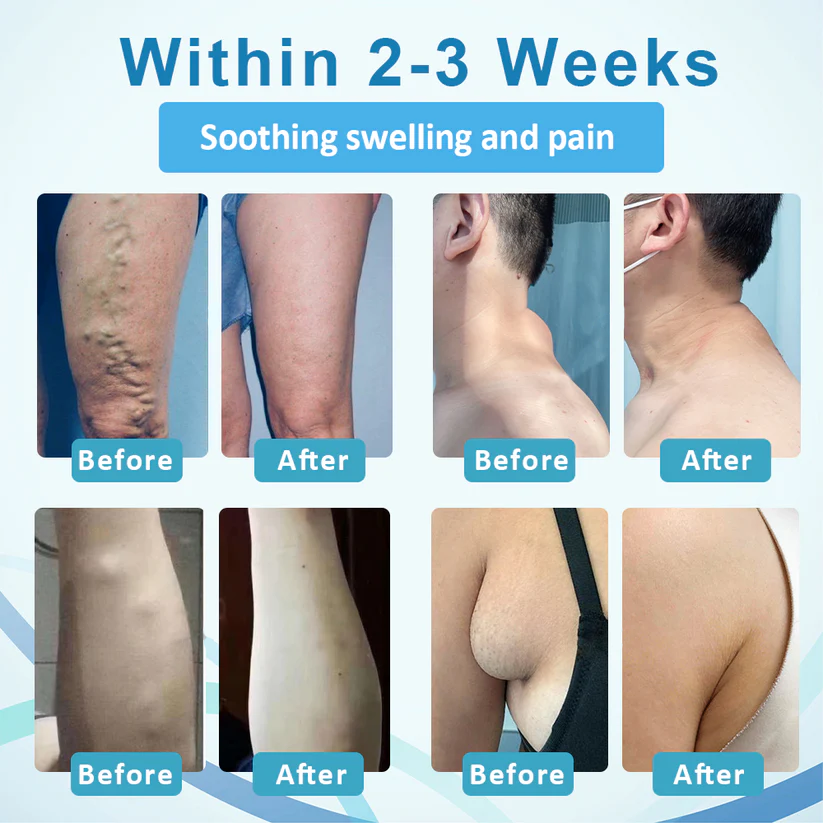 LIMITED TIME SALE OFF 60%đ„ CvreozÂź LumpsClear Lymph Support Roll-On