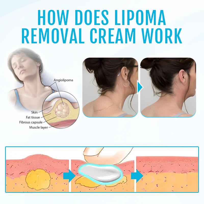 ⏰Last Day Promotion: 60% OFF🔥 Cvreoz® Lipoma Removal Cream