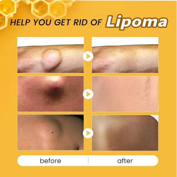 đ„ Sale up to 60% - Order NOW! đ„ CvreozÂź Bee Venom Lipoma Removal Cream