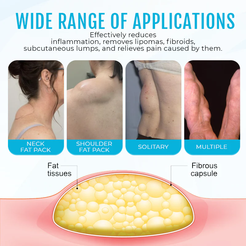⏰Last Day Promotion: 60% OFF🔥 Cvreoz® Lipoma Removal Cream