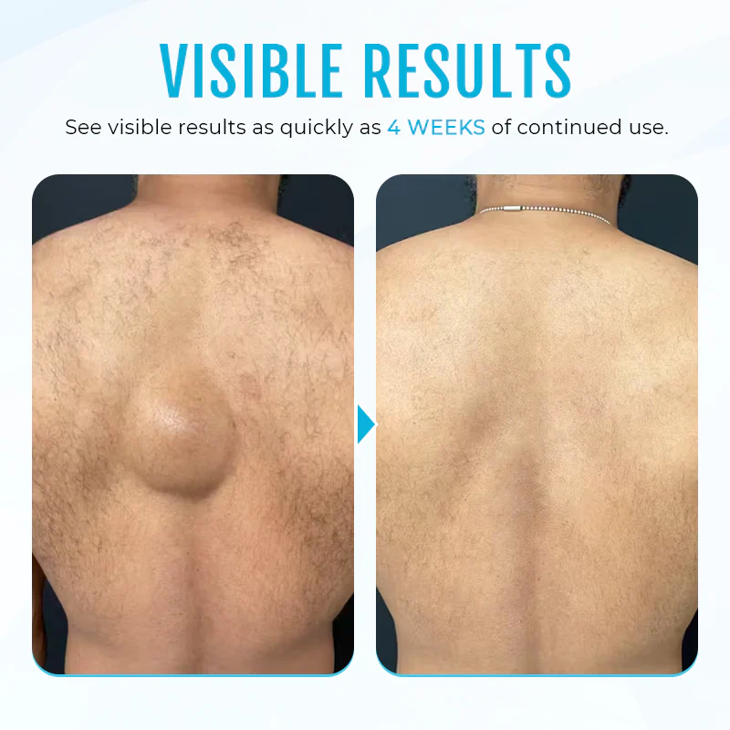 ⏰Last Day Promotion: 60% OFF🔥 Cvreoz® Lipoma Removal Cream