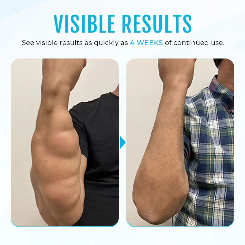 ⏰Last Day Promotion: 60% OFF🔥 Cvreoz® Lipoma Removal Cream