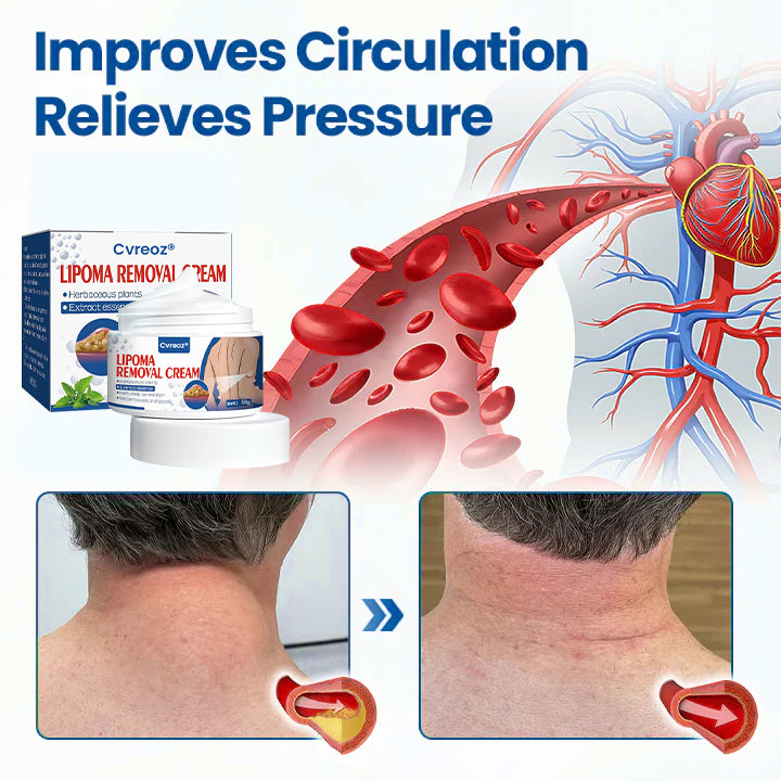 ⏰Last Day Promotion: 60% OFF🔥 Cvreoz® Lipoma Removal Cream