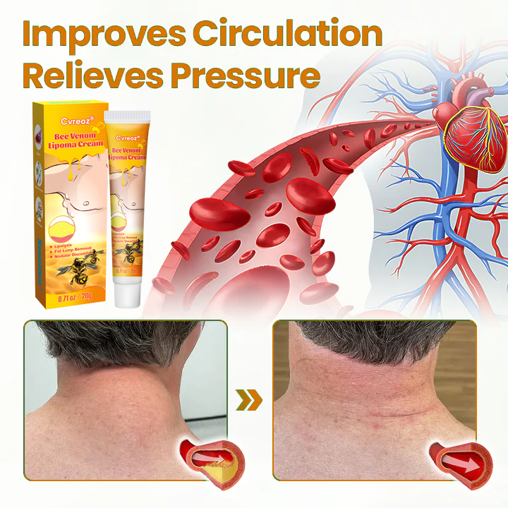 đ„ Sale up to 60% - Order NOW! đ„ CvreozÂź Bee Venom Lipoma Removal Cream