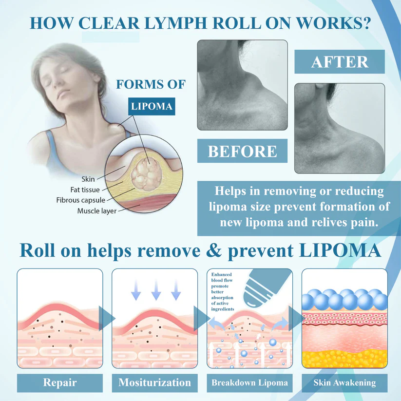 LIMITED TIME SALE OFF 60%đ„ CvreozÂź LumpsClear Lymph Support Roll-On