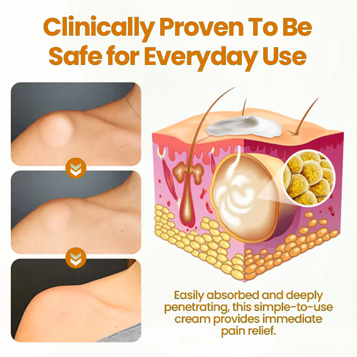 đ„ Sale up to 60% - Order NOW! đ„ CvreozÂź Bee Venom Lipoma Removal Cream