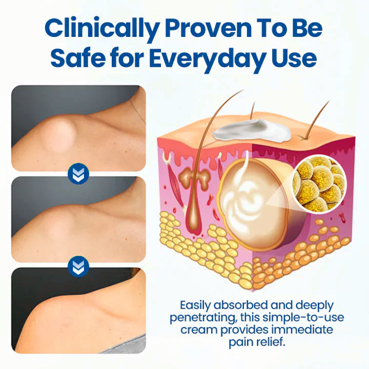 ⏰Last Day Promotion: 60% OFF🔥 Cvreoz® Lipoma Removal Cream