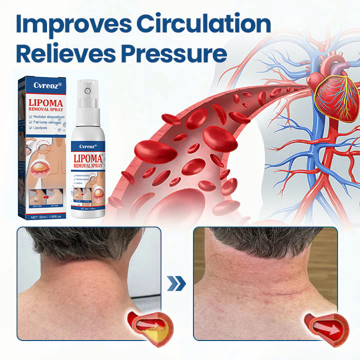 ⏰Last Day Promotion: 60% OFF🔥 Cvreoz® BumpGone Lipoma Treatment Spray
