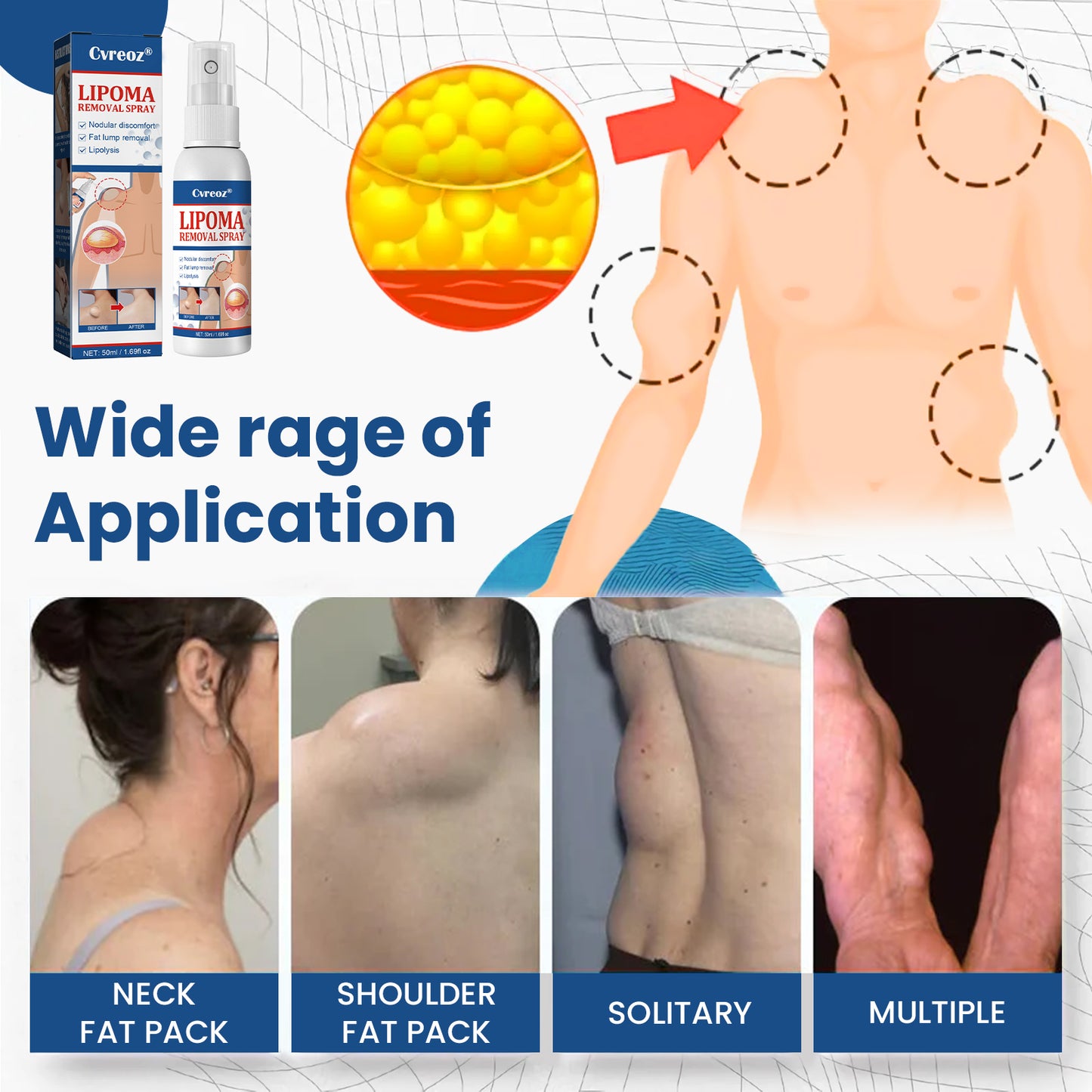 ⏰Last Day Promotion: 60% OFF🔥 Cvreoz® BumpGone Lipoma Treatment Spray