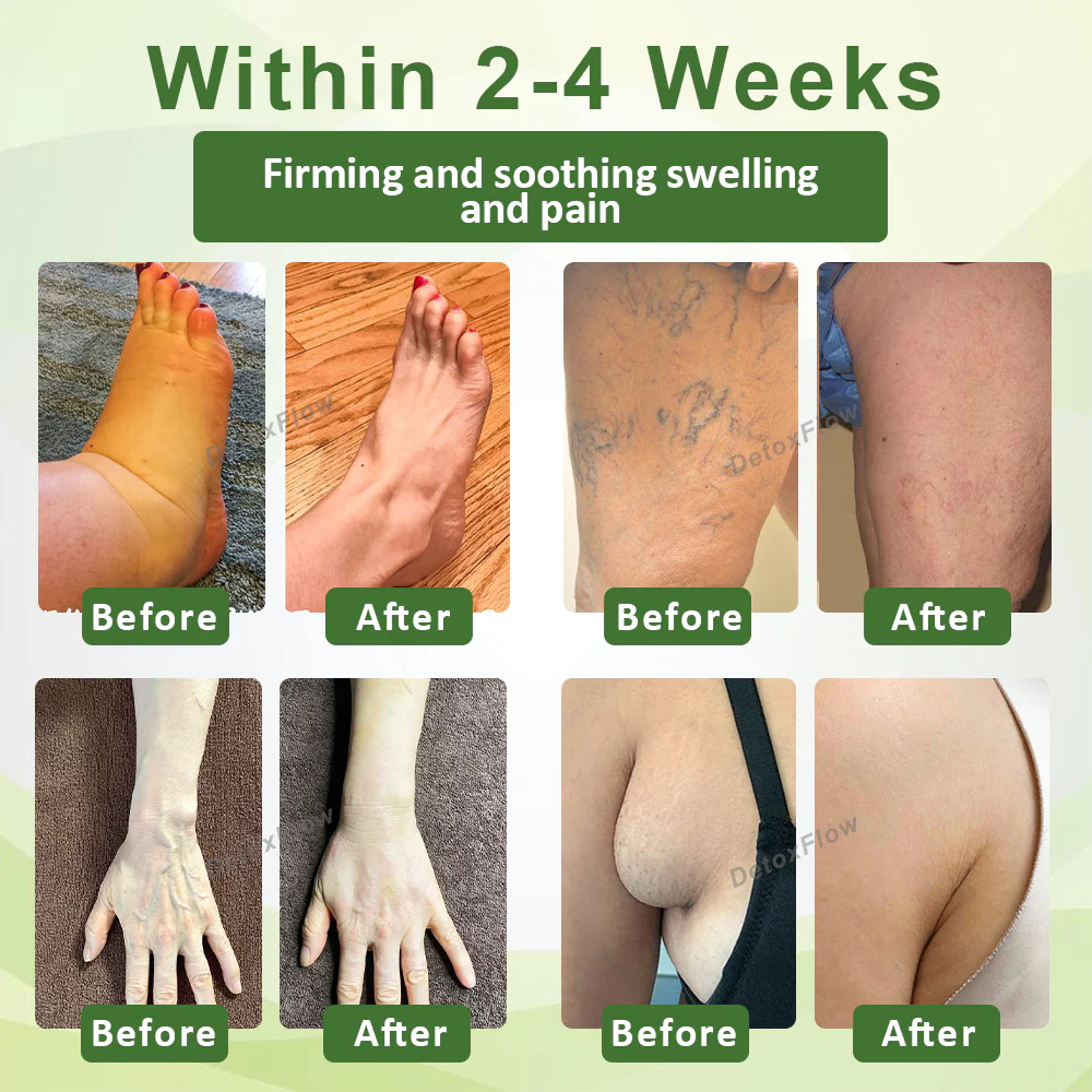 ⏰Last Day Promotion: 60% OFF🔥 Cvreoz® Lymphatic Detox Herbal Cream