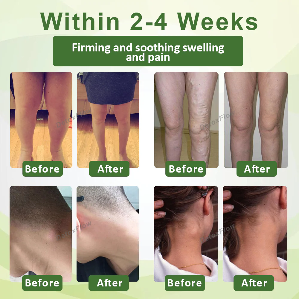 ⏰Last Day Promotion: 60% OFF🔥 Cvreoz® Lymphatic Detox Herbal Cream