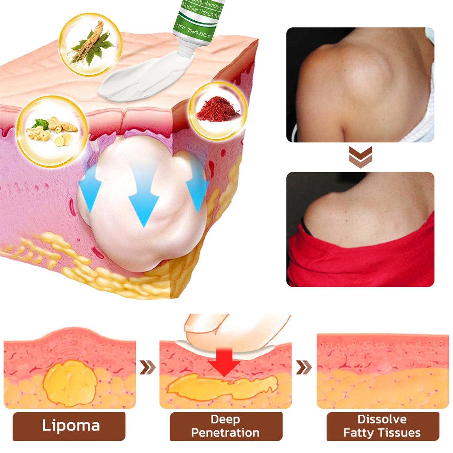🔥Last Day Promotion: 60% OFF🔥 Cvreoz® LipomaCure Soothing Ointment