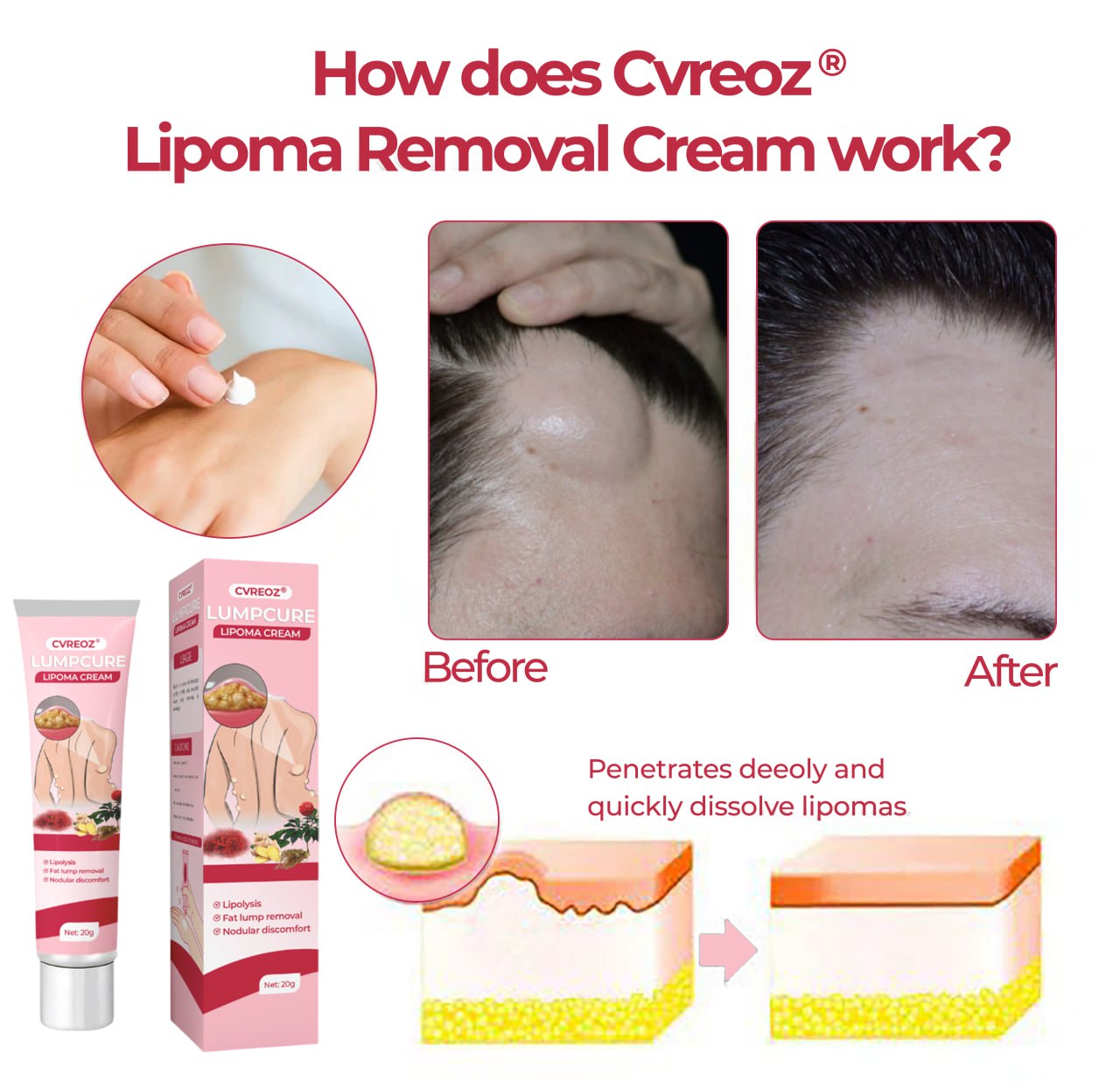 🩷 CVREOZ® LumpCure Lipoma Cream 🔥 SUMMER SALE 60%