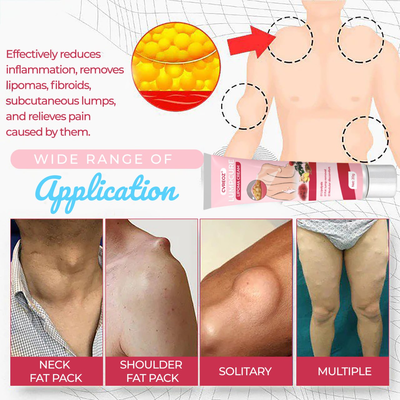 🩷 CVREOZ® LumpCure Lipoma Cream 🔥 SUMMER SALE 60%