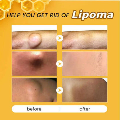 🔥 Sale up to 60% - Order NOW! 🔥 Cvreoz® Bee Venom  Lipoma Removal Cream