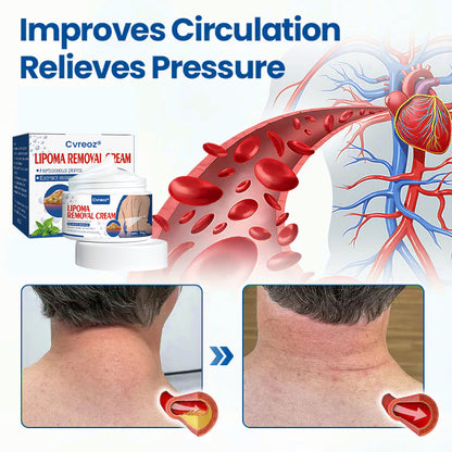 ⏰Last Day Promotion: 60% OFF🔥 Cvreoz® Lipoma Removal Cream