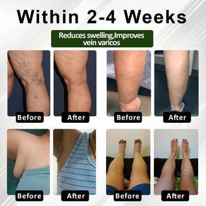 Cvreoz® FlowEase Leg Therapy Edema Cream