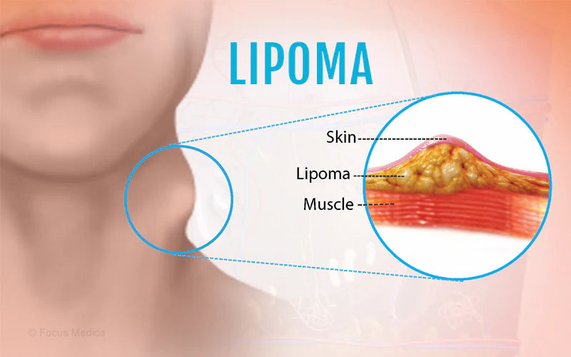 Cvreoz® Lipoma Removal Cream image Cvreoz® Lipoma Removal Cream