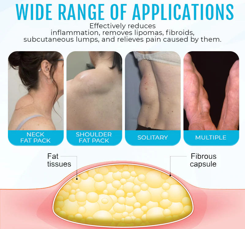 Cvreoz® Lipoma Removal Cream