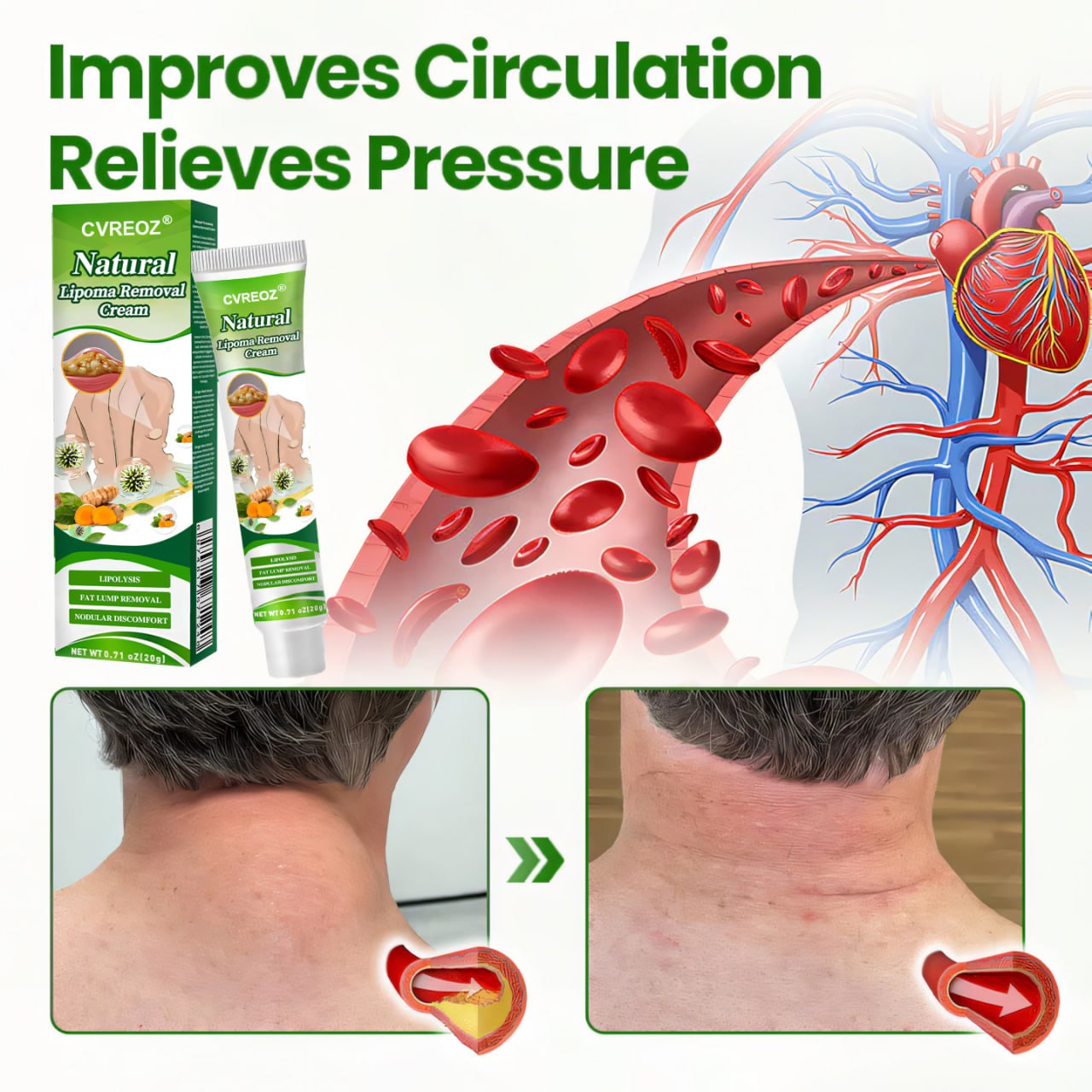 🔥 Limited Deal - 60% OFF! 🔥 Cvreoz® Natural Lipoma Removal Cream