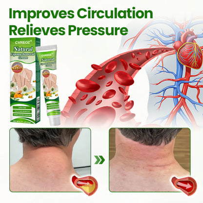 🔥 Limited Deal - 60% OFF! 🔥 Cvreoz® Natural Lipoma Removal Cream