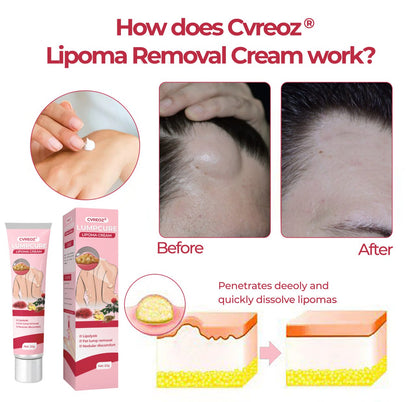 🩷 CVREOZ® LumpCure Lipoma Cream 🔥 SUMMER SALE 60%
